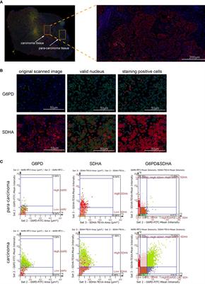 Lactate Modulates Cellular Metabolism Through Histone Lactylation-Mediated Gene Expression in Non-Small Cell Lung Cancer